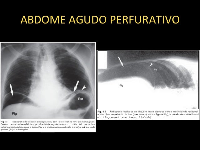 abdome agudo perfurativo